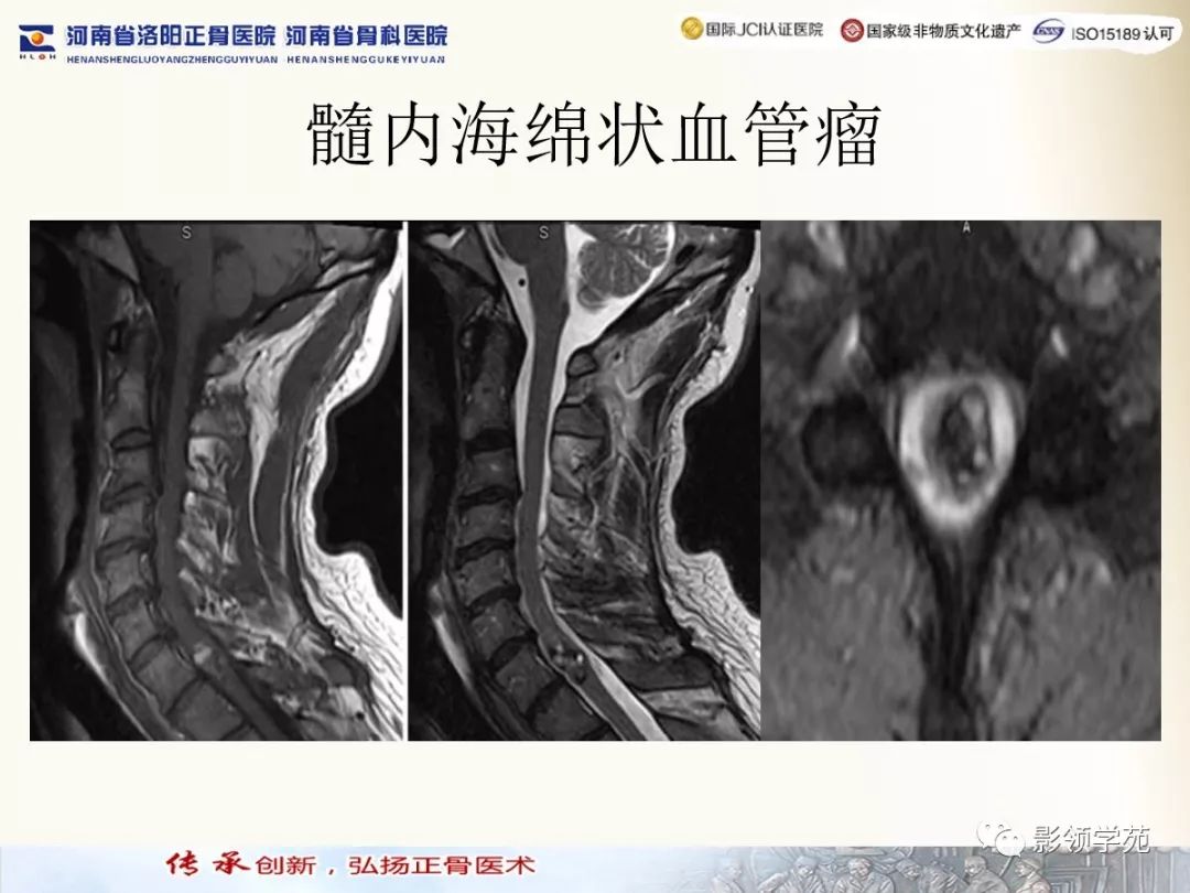 影像PPT - 【PPT】椎管内常见肿瘤MR诊断-16 影像PPT - 【PPT】椎管内常见肿瘤MR诊断-16