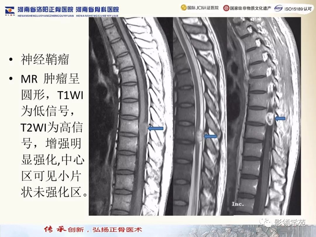 影像PPT - 【PPT】椎管内常见肿瘤MR诊断-20 影像PPT - 【PPT】椎管内常见肿瘤MR诊断-20