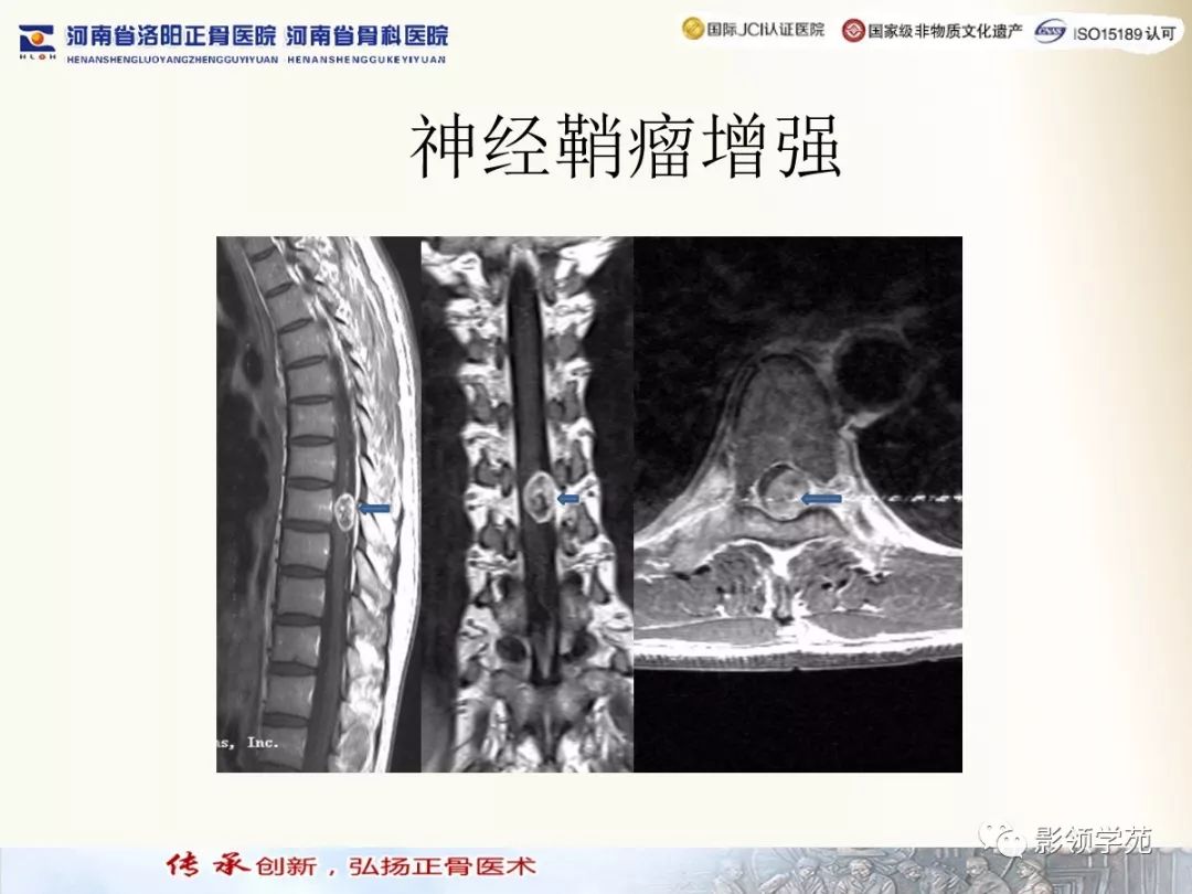 影像PPT - 【PPT】椎管内常见肿瘤MR诊断-21 影像PPT - 【PPT】椎管内常见肿瘤MR诊断-21