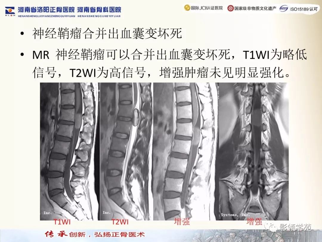影像PPT - 【PPT】椎管内常见肿瘤MR诊断-22 影像PPT - 【PPT】椎管内常见肿瘤MR诊断-22