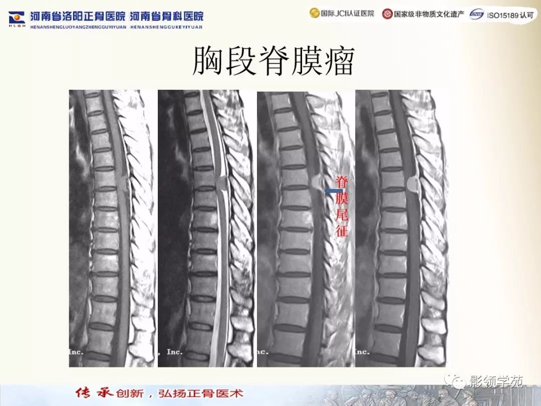 影像PPT - 【PPT】椎管内常见肿瘤MR诊断-25 影像PPT - 【PPT】椎管内常见肿瘤MR诊断-25