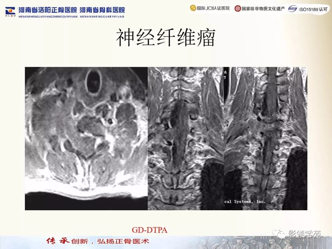 影像PPT - 【PPT】椎管内常见肿瘤MR诊断-30 影像PPT - 【PPT】椎管内常见肿瘤MR诊断-30