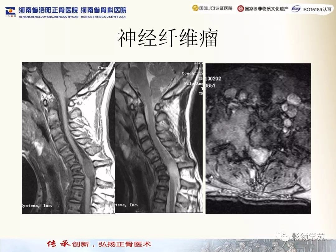 影像PPT - 【PPT】椎管内常见肿瘤MR诊断-29 影像PPT - 【PPT】椎管内常见肿瘤MR诊断-29