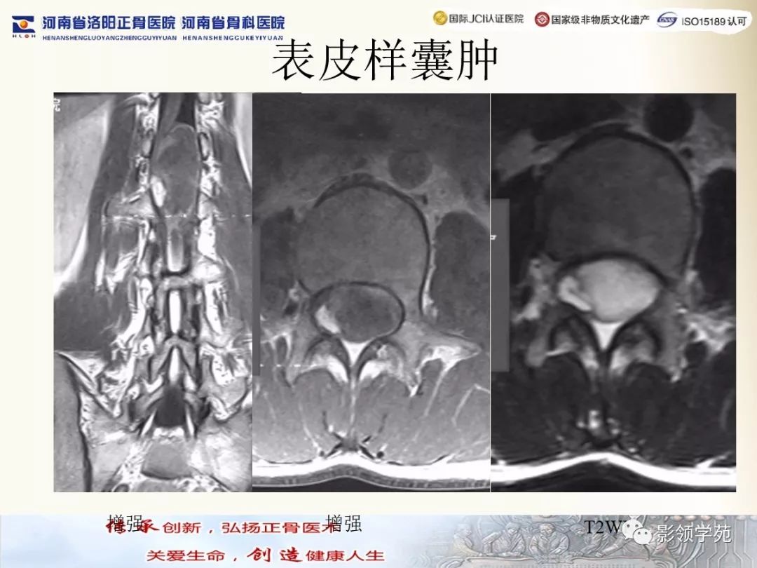 影像PPT - 【PPT】椎管内常见肿瘤MR诊断-33 影像PPT - 【PPT】椎管内常见肿瘤MR诊断-33