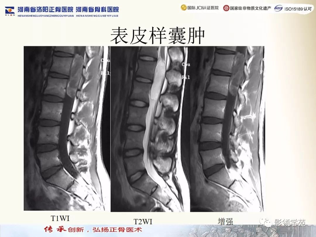 影像PPT - 【PPT】椎管内常见肿瘤MR诊断-32 影像PPT - 【PPT】椎管内常见肿瘤MR诊断-32