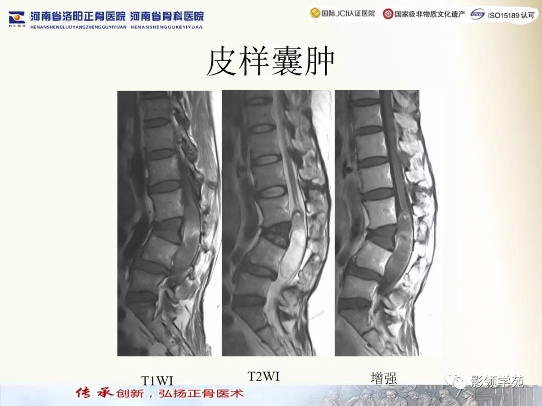 影像PPT - 【PPT】椎管内常见肿瘤MR诊断-35 影像PPT - 【PPT】椎管内常见肿瘤MR诊断-35