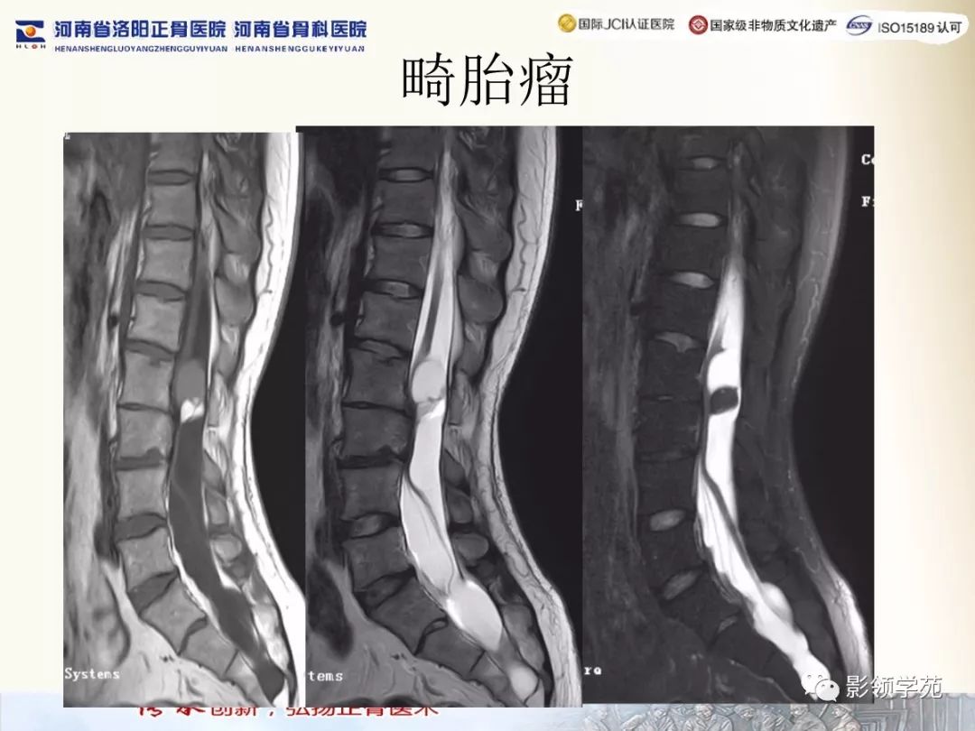 影像PPT - 【PPT】椎管内常见肿瘤MR诊断-40 影像PPT - 【PPT】椎管内常见肿瘤MR诊断-40