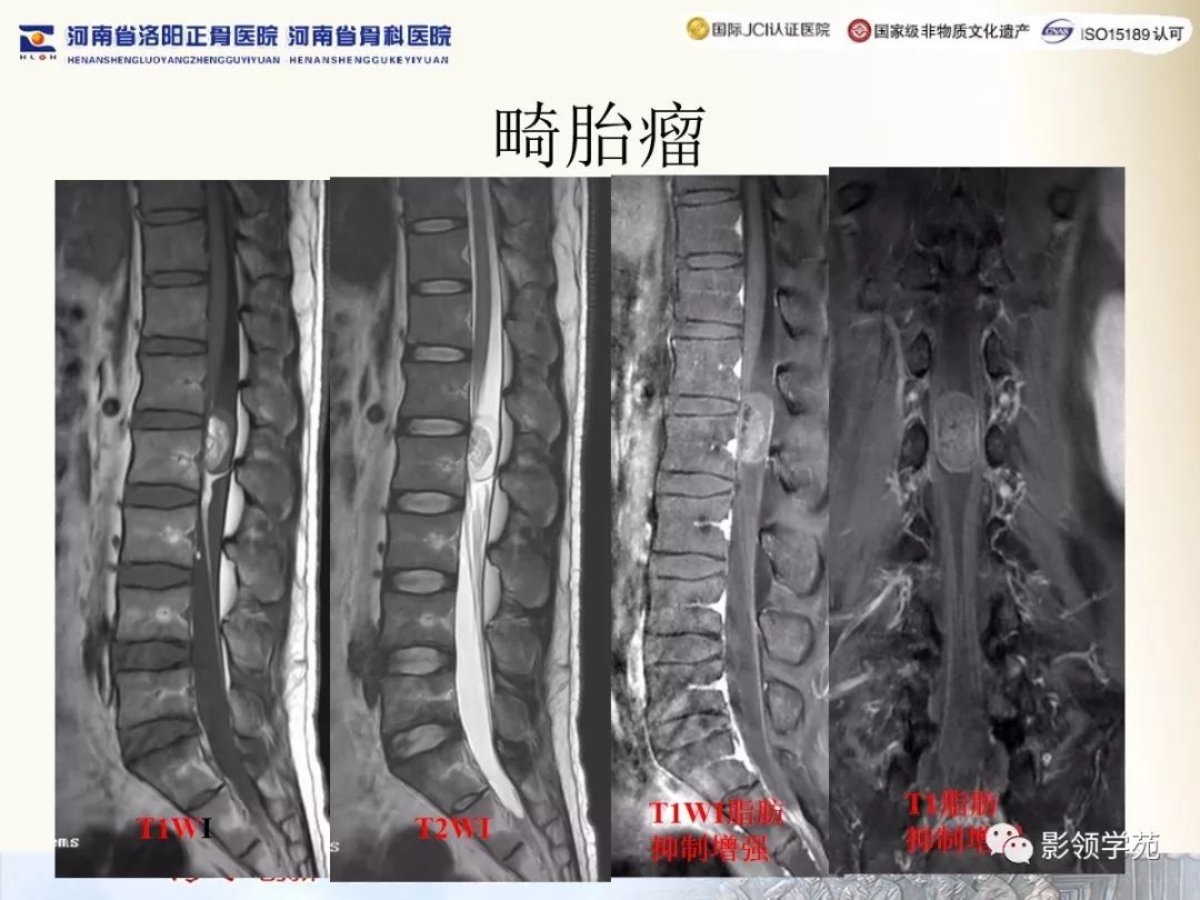 影像PPT - 【PPT】椎管内常见肿瘤MR诊断-39 影像PPT - 【PPT】椎管内常见肿瘤MR诊断-39