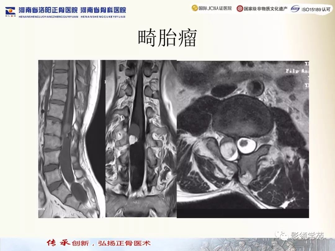影像PPT - 【PPT】椎管内常见肿瘤MR诊断-41 影像PPT - 【PPT】椎管内常见肿瘤MR诊断-41