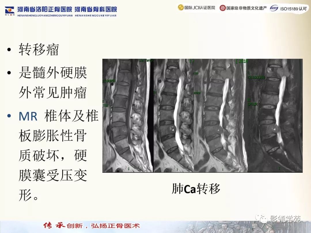 影像PPT - 【PPT】椎管内常见肿瘤MR诊断-43 影像PPT - 【PPT】椎管内常见肿瘤MR诊断-43