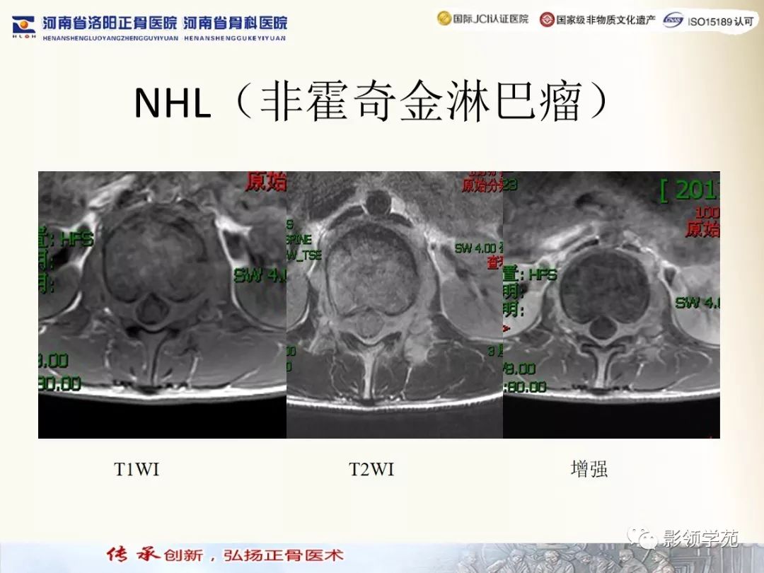 影像PPT - 【PPT】椎管内常见肿瘤MR诊断-45 影像PPT - 【PPT】椎管内常见肿瘤MR诊断-45