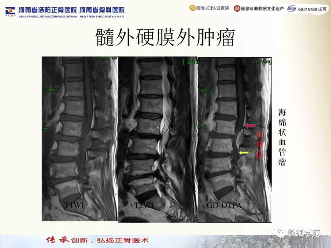影像PPT - 【PPT】椎管内常见肿瘤MR诊断-47 影像PPT - 【PPT】椎管内常见肿瘤MR诊断-47