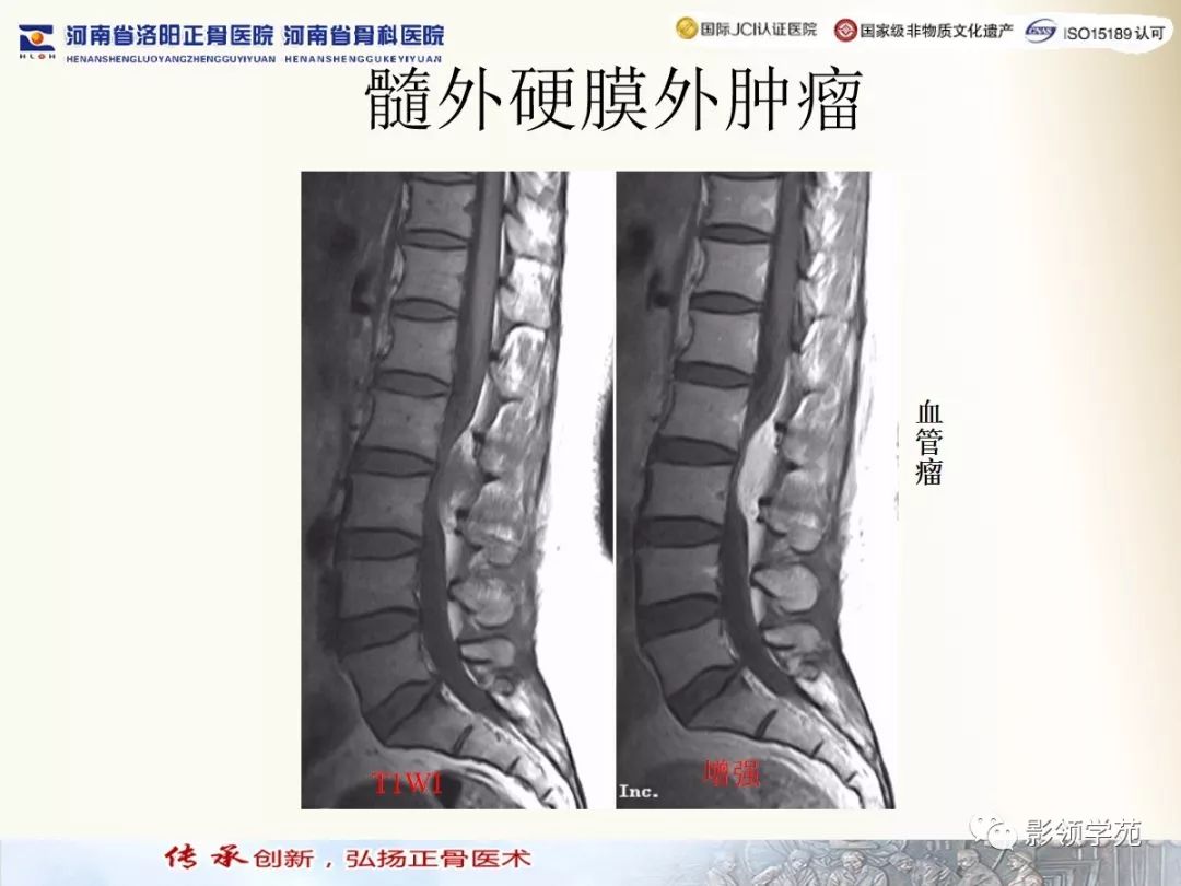 影像PPT - 【PPT】椎管内常见肿瘤MR诊断-48 影像PPT - 【PPT】椎管内常见肿瘤MR诊断-48
