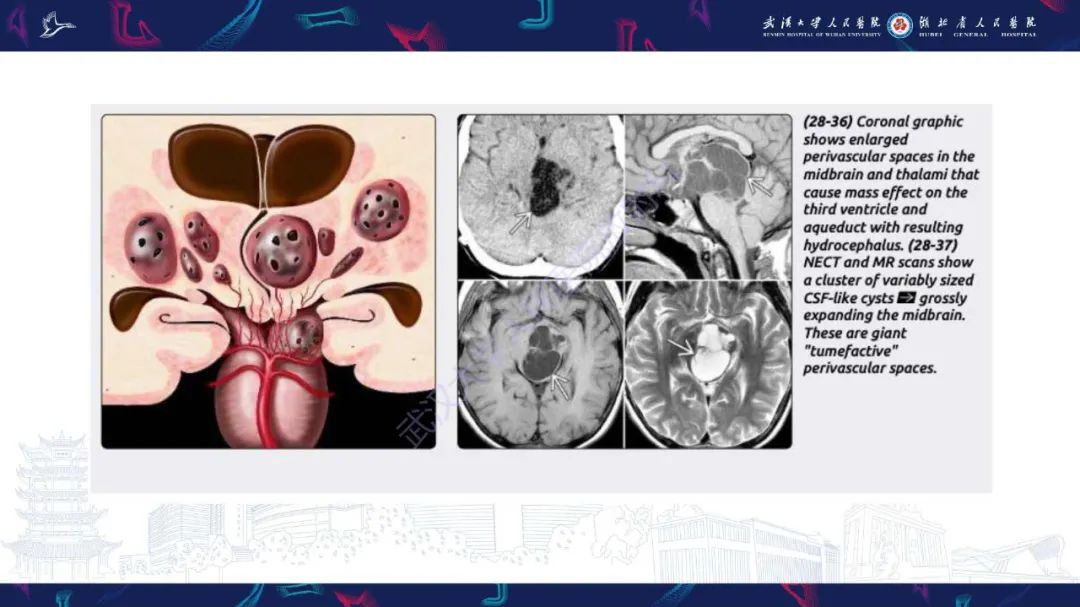 影像PPT - 【PPT】脑内单发囊性病变影像诊断-11