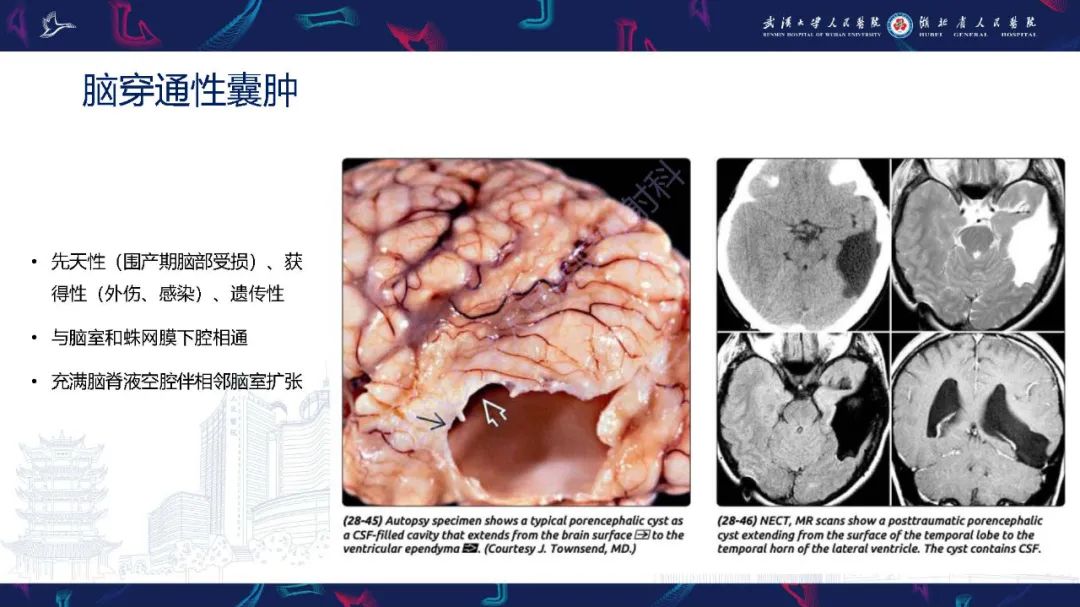 影像PPT - 【PPT】脑内单发囊性病变影像诊断-12