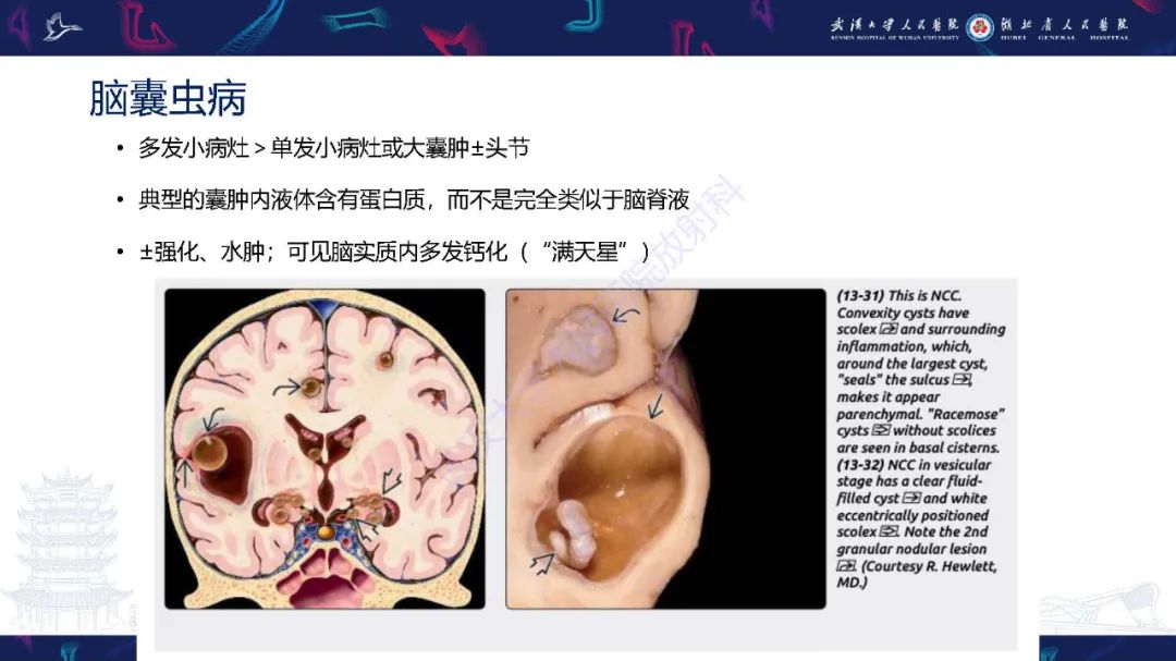 影像PPT - 【PPT】脑内单发囊性病变影像诊断-17
