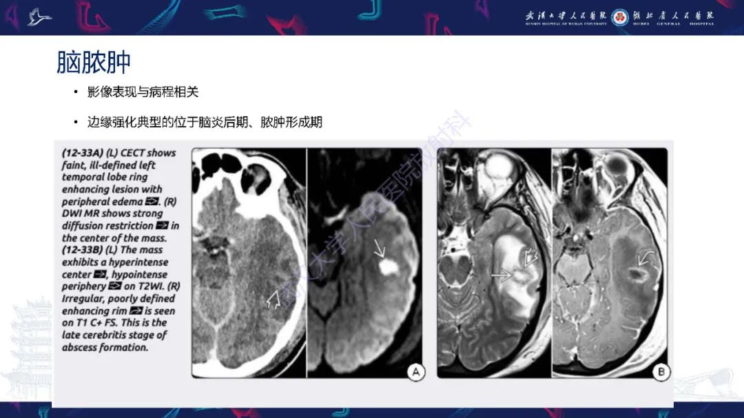 影像PPT - 【PPT】脑内单发囊性病变影像诊断-19