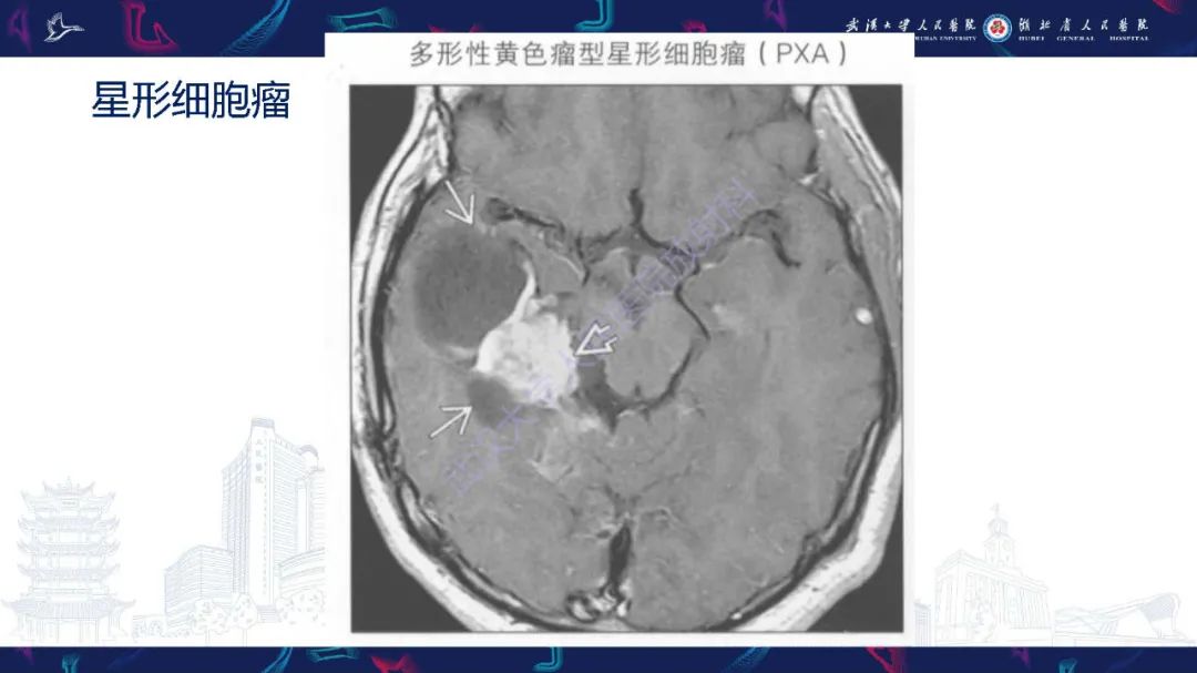 影像PPT - 【PPT】脑内单发囊性病变影像诊断-22