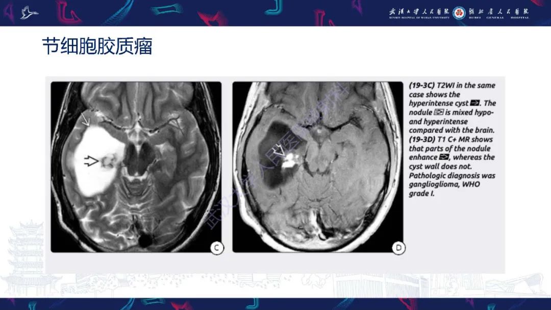 影像PPT - 【PPT】脑内单发囊性病变影像诊断-27