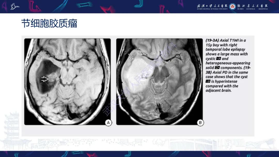 影像PPT - 【PPT】脑内单发囊性病变影像诊断-26