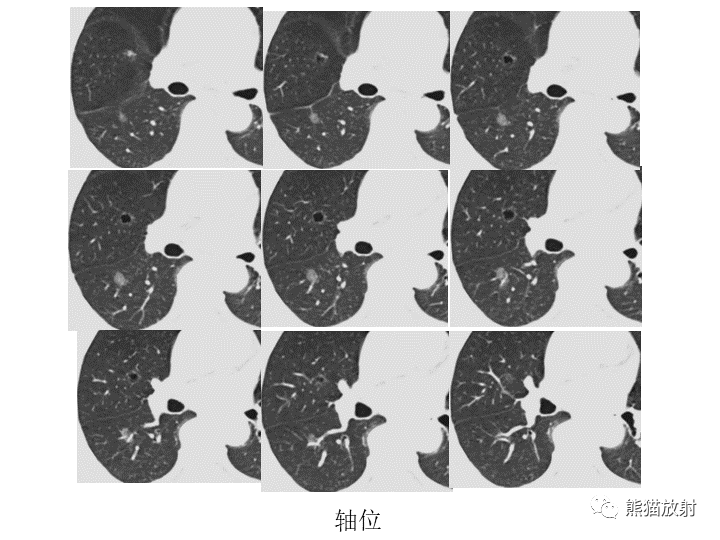 影像PPT - 【病例】肺腺癌（囊腔类肺癌）VS 肺局灶碳末沉积-3
