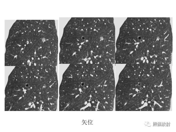 影像PPT - 【病例】肺腺癌（囊腔类肺癌）VS 肺局灶碳末沉积-5