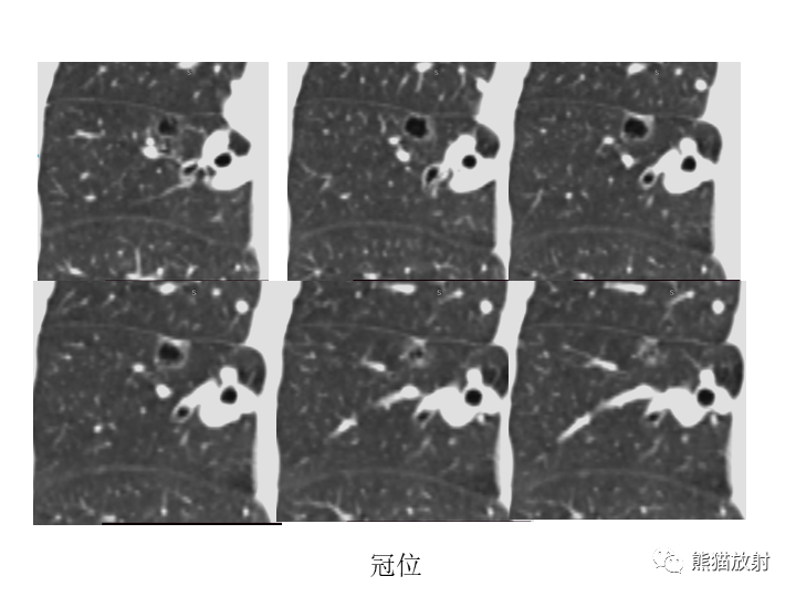 影像PPT - 【病例】肺腺癌（囊腔类肺癌）VS 肺局灶碳末沉积-4