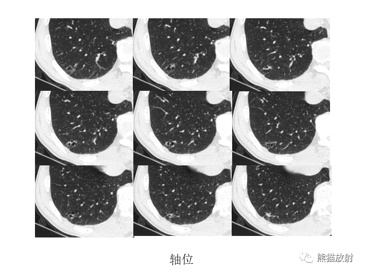 影像PPT - 【病例】肺腺癌（囊腔类肺癌）VS 肺局灶碳末沉积-9