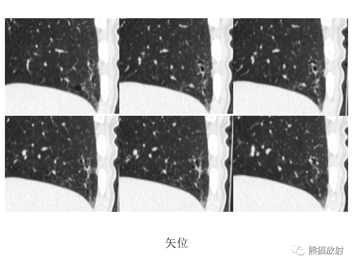 影像PPT - 【病例】肺腺癌（囊腔类肺癌）VS 肺局灶碳末沉积-11