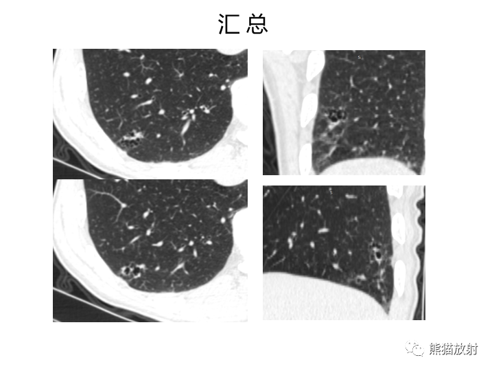 影像PPT - 【病例】肺腺癌（囊腔类肺癌）VS 肺局灶碳末沉积-12