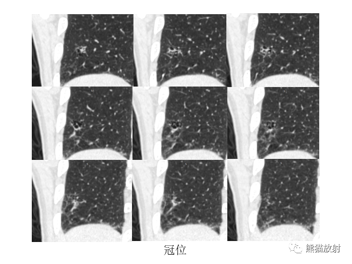 影像PPT - 【病例】肺腺癌（囊腔类肺癌）VS 肺局灶碳末沉积-10