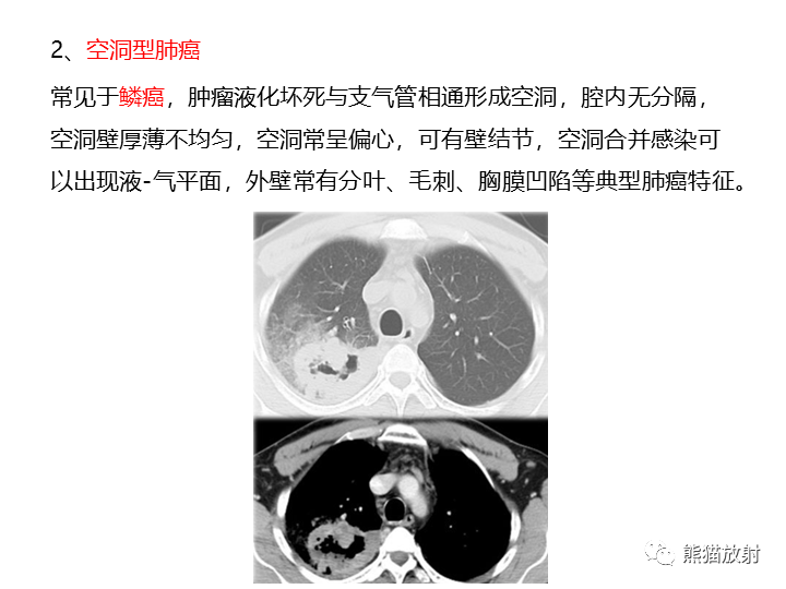 影像PPT - 【病例】肺腺癌（囊腔类肺癌）VS 肺局灶碳末沉积-28