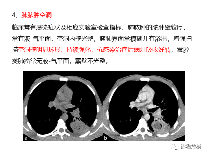 影像PPT - 【病例】肺腺癌（囊腔类肺癌）VS 肺局灶碳末沉积-30