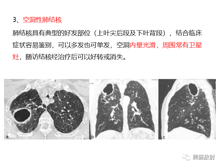 影像PPT - 【病例】肺腺癌（囊腔类肺癌）VS 肺局灶碳末沉积-29