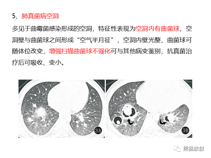 影像PPT - 【病例】肺腺癌（囊腔类肺癌）VS 肺局灶碳末沉积-31