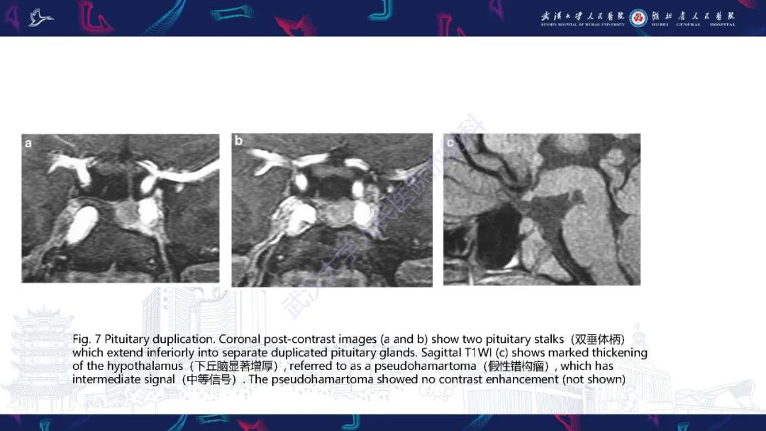影像PPT - 【PPT】儿童鞍区病变磁共振诊断-18