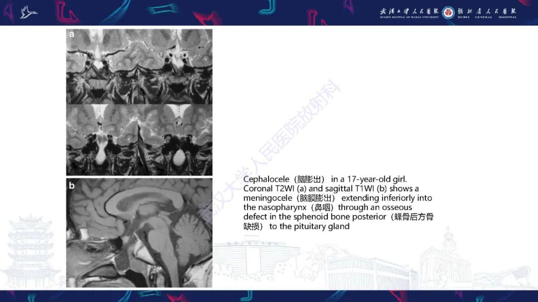 影像PPT - 【PPT】儿童鞍区病变磁共振诊断-27