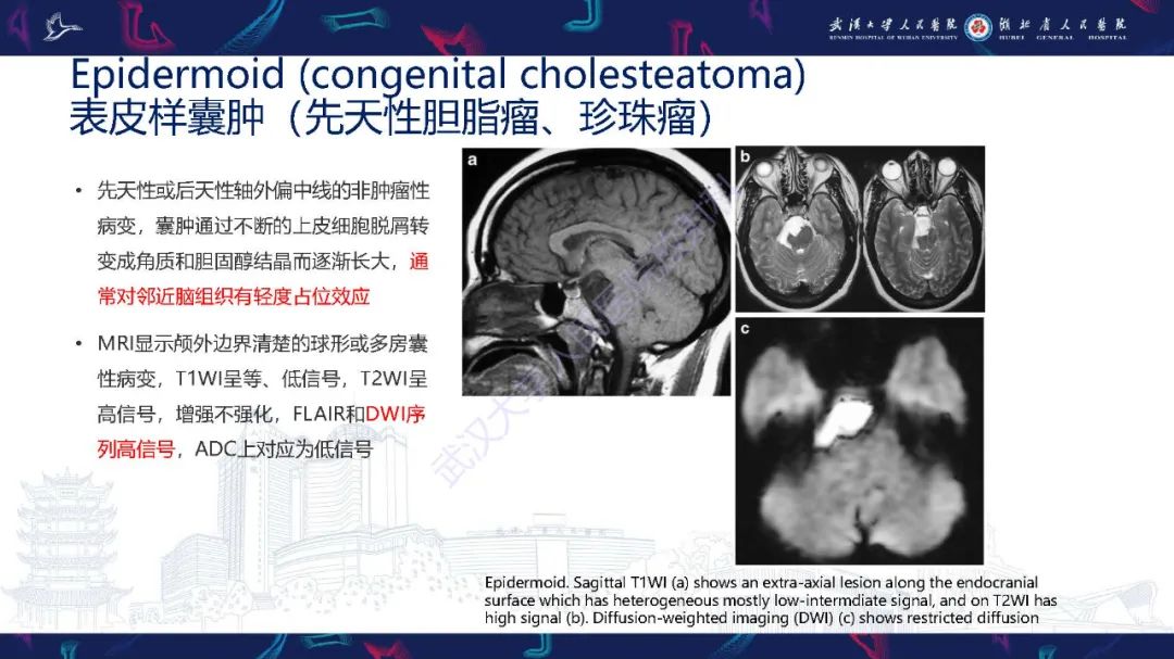 影像PPT - 【PPT】儿童鞍区病变磁共振诊断-28