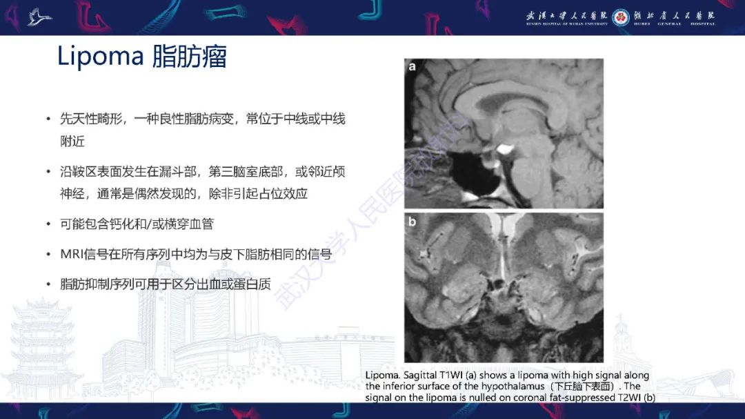 影像PPT - 【PPT】儿童鞍区病变磁共振诊断-31