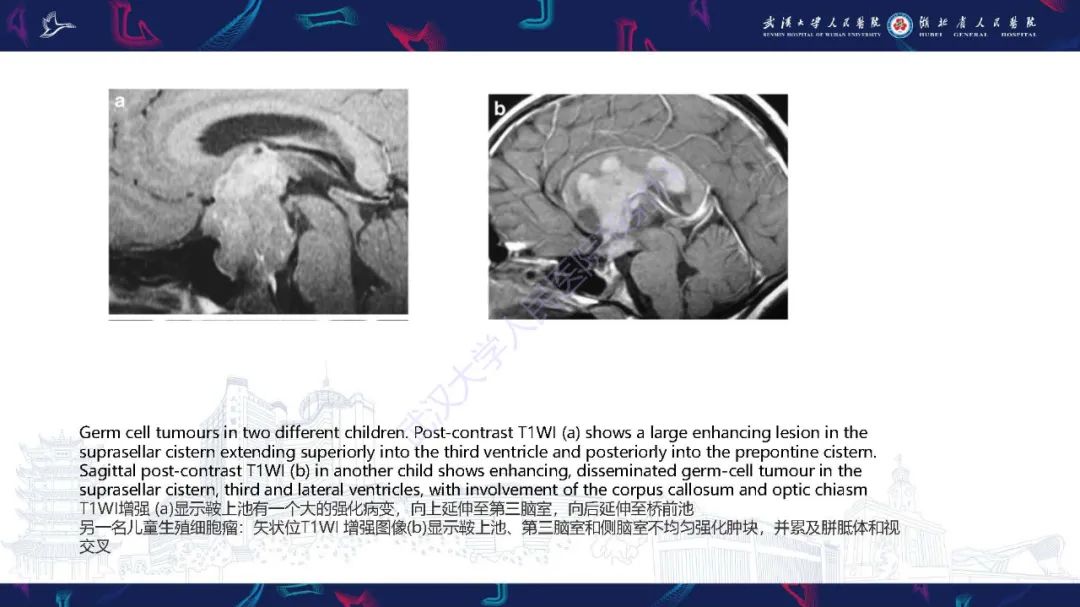 影像PPT - 【PPT】儿童鞍区病变磁共振诊断-43