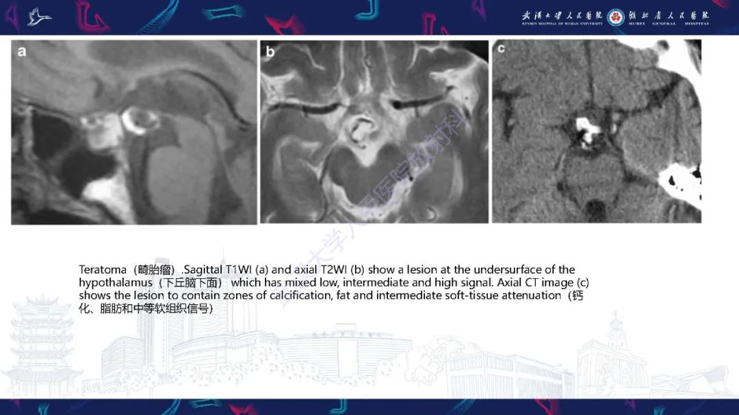 影像PPT - 【PPT】儿童鞍区病变磁共振诊断-45