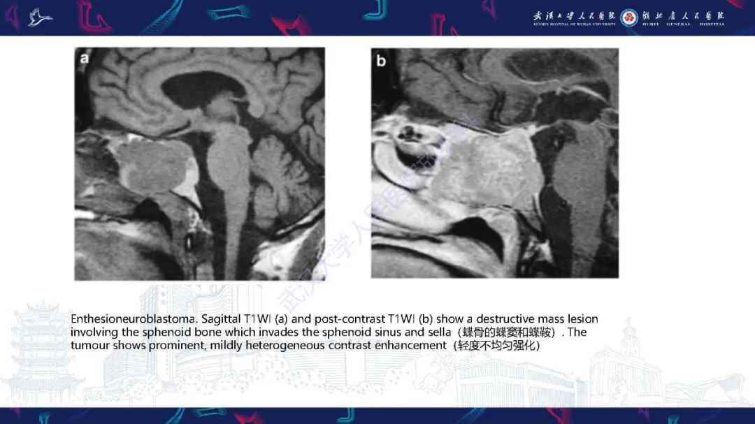 影像PPT - 【PPT】儿童鞍区病变磁共振诊断-51