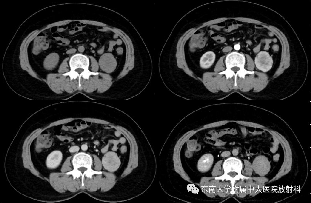 影像PPT - 【PPT】肾嗜酸细胞腺瘤的影像-1