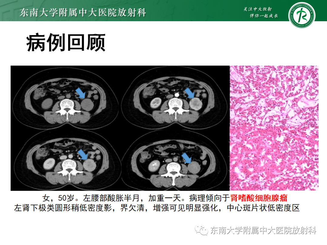 影像PPT - 【PPT】肾嗜酸细胞腺瘤的影像-2