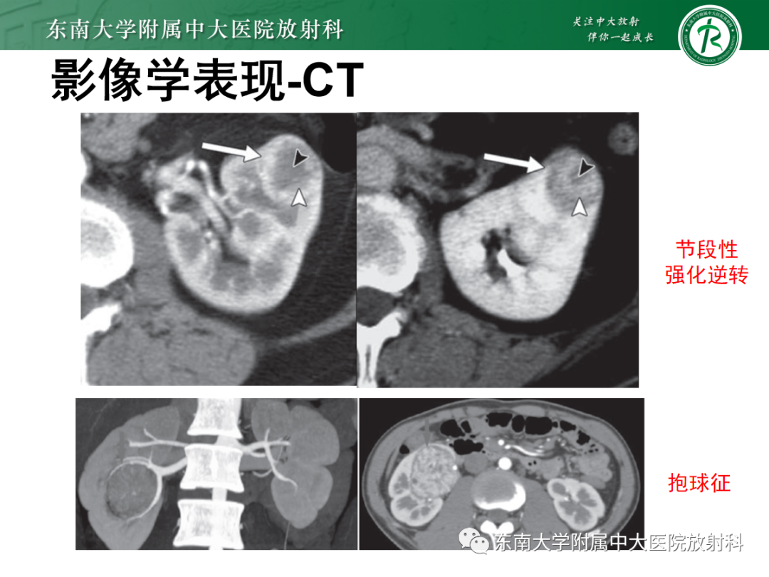 影像PPT - 【PPT】肾嗜酸细胞腺瘤的影像-8