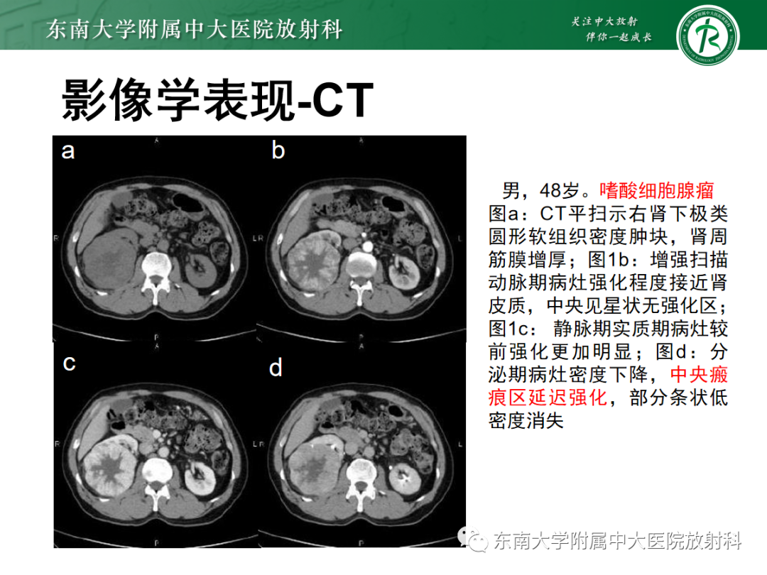 影像PPT - 【PPT】肾嗜酸细胞腺瘤的影像-7