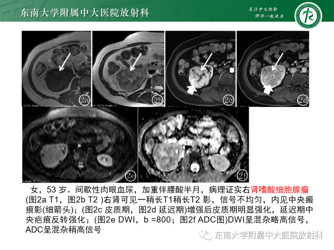 影像PPT - 【PPT】肾嗜酸细胞腺瘤的影像-10