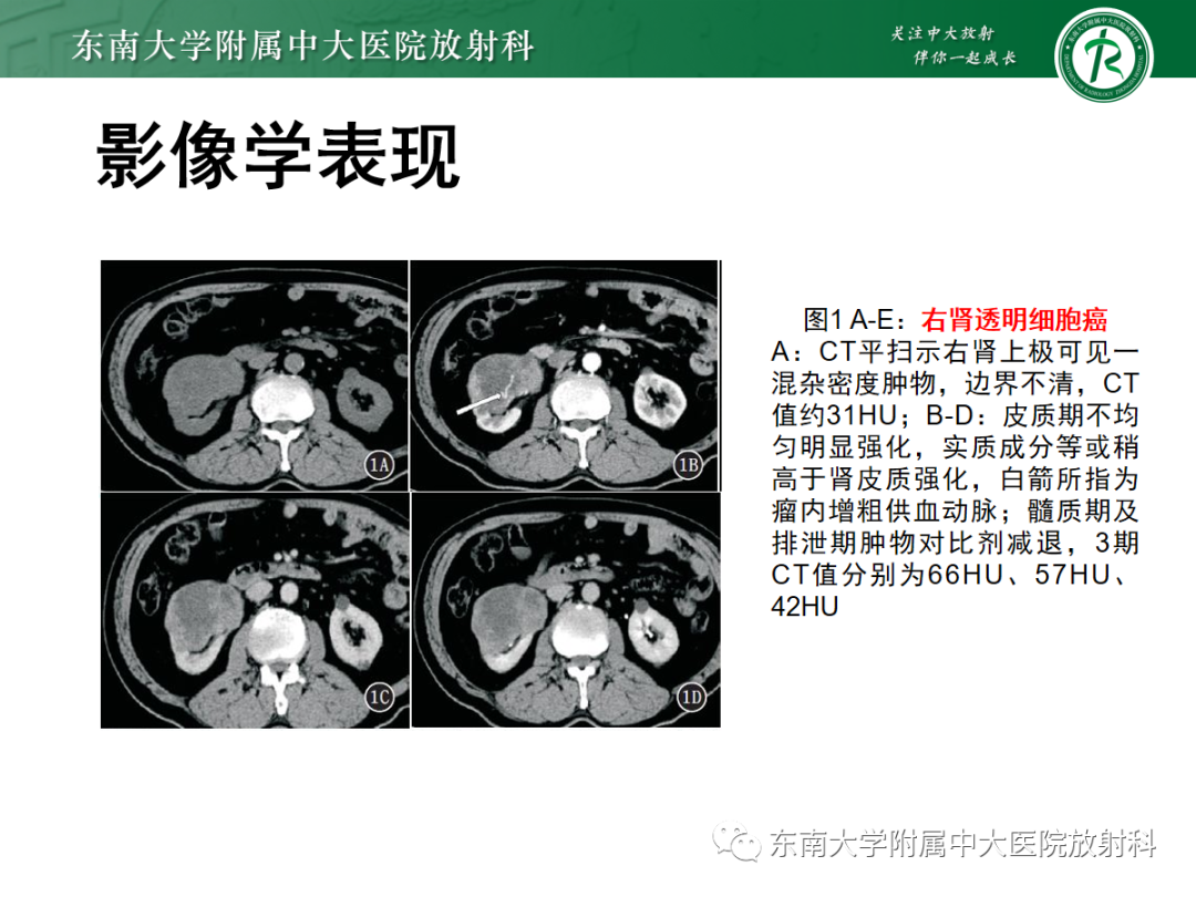 影像PPT - 【PPT】肾嗜酸细胞腺瘤的影像-13
