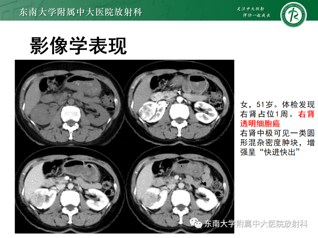 影像PPT - 【PPT】肾嗜酸细胞腺瘤的影像-14