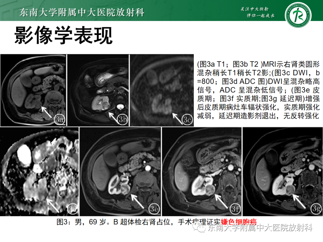 影像PPT - 【PPT】肾嗜酸细胞腺瘤的影像-16